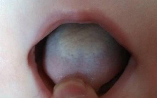 宝宝|中医食疗加推拿安全高效“积食”导致宝宝剧烈咳嗽