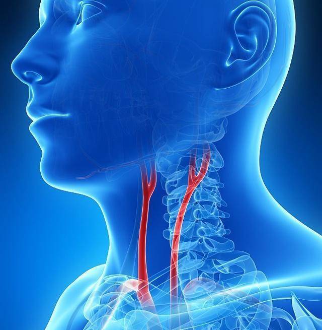 身体发现4个表现时，也许是颈动脉出现斑块“信号”，一定别忽视