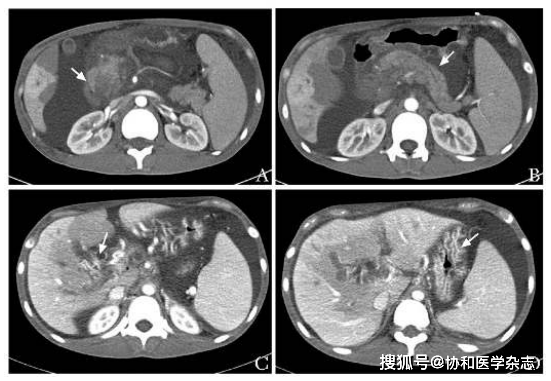 门静脉|腹痛,十二指肠溃疡,门静脉高压:非一般性“胰腺占位”