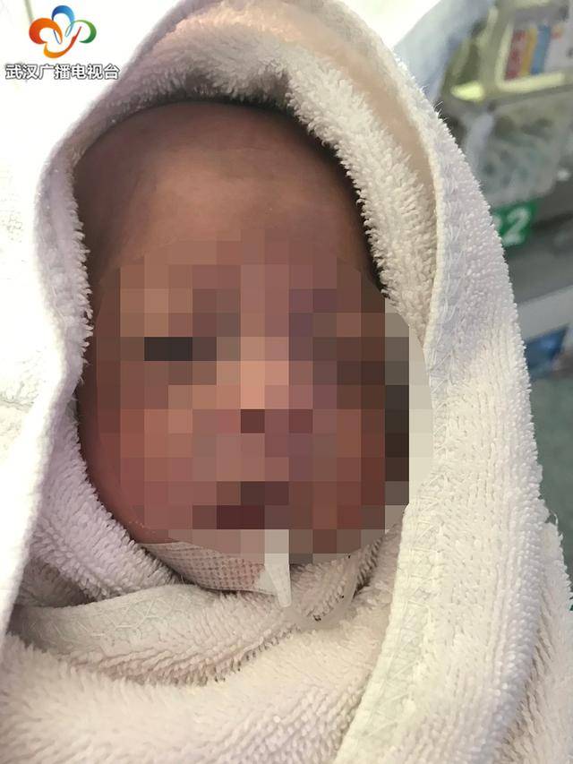 女婴|不容易！6个月超早产女婴活下来了 出生时仅500克