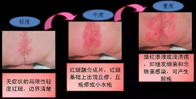 皮肤|金牌月嫂都佩服宝宝湿疹、痱子、口水疹怎么办？达人宝妈有法宝