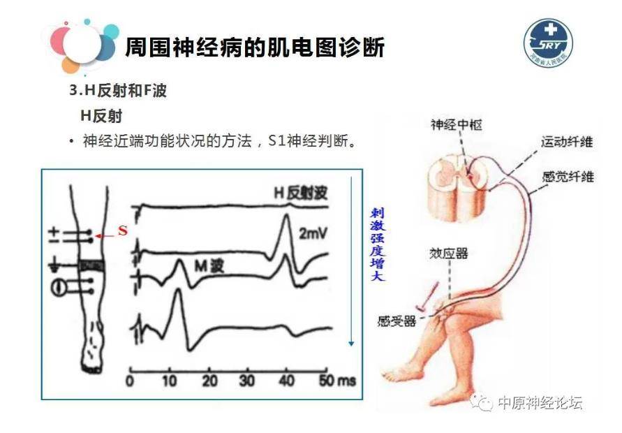 肌电图周围神经病与肌电图诊断