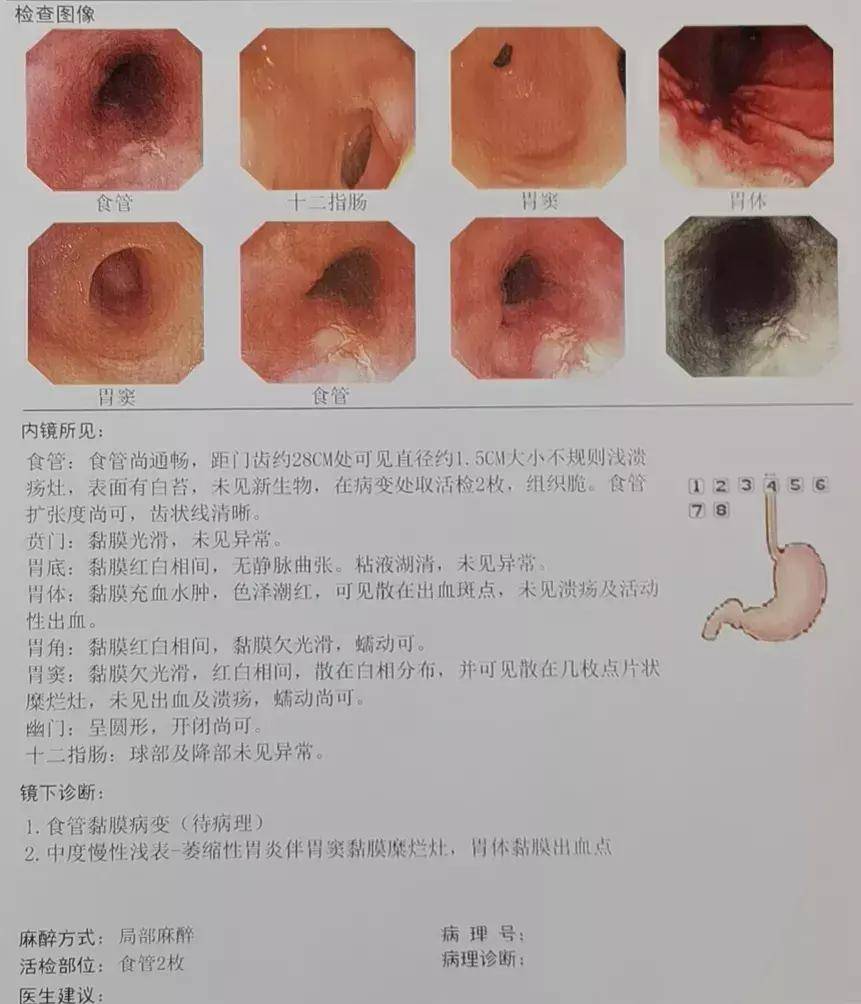 食道炎"去当地医院就诊后还时不时地出现反酸1个月前胸骨后有隐约的不