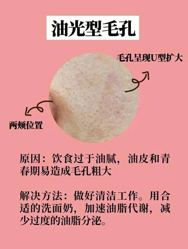三,油光型毛孔