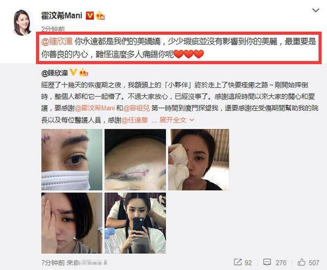 打脸了！阿娇大方晒伤口照，好长缝合线看着好