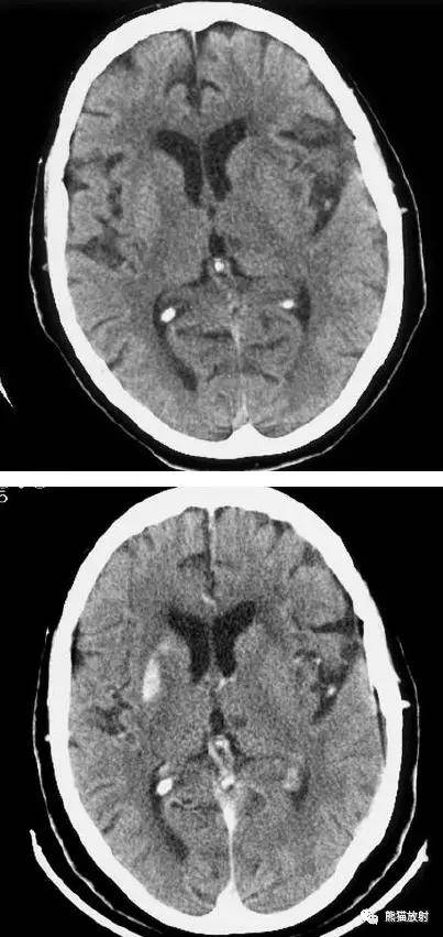 脑血管病 脑梗死的演变,血供区域分布,ct表现