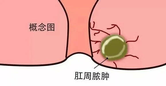 肛周脓肿破溃怎么治疗呢