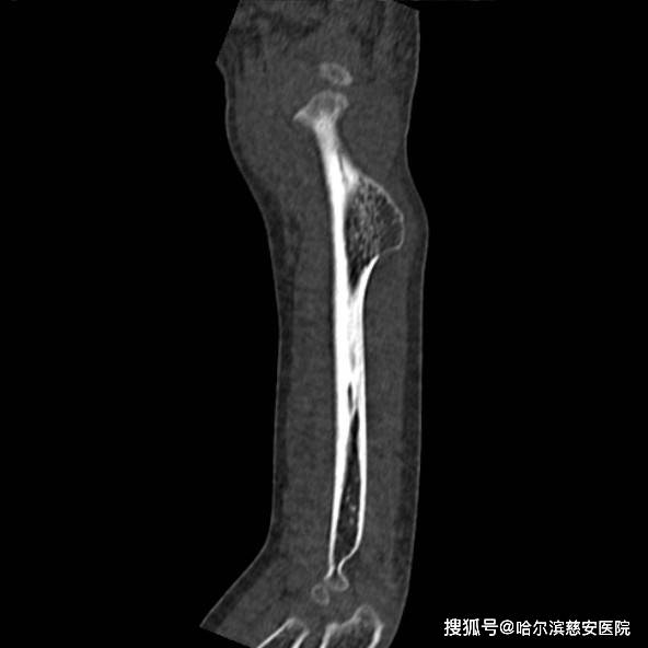 【科普】骨软骨瘤病