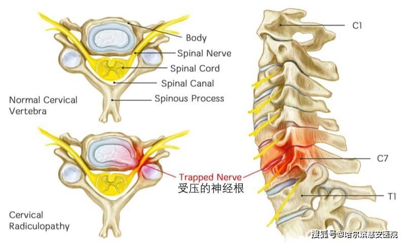 科普神经根型颈椎病