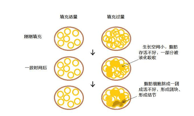 结节!肿块!韦元强讲解解决自体脂肪丰胸并发症的难点在哪