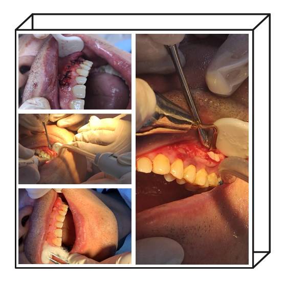 口腔患者诊疗病状为:全口牙多发性牙槽骨骨质增生,牙槽骨骨质增生1