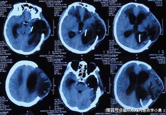 车祸脑外伤脑积水性脑膨出,外院7个月内4次住院治疗后脑积水脑膨出无