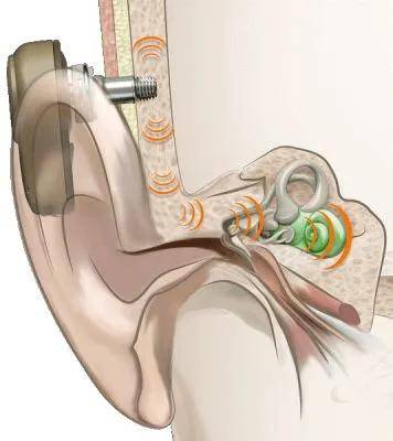 小耳畸形的听力补偿方式-ponto3骨导助听器