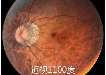 如果孩子近视每年增长都超过50度一定要引起重视_手机搜狐网