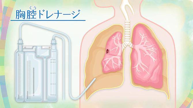 男性常见的气胸是什么?症状,疾病,治疗方法