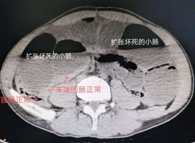 术前ct示小肠扩张,积气积液