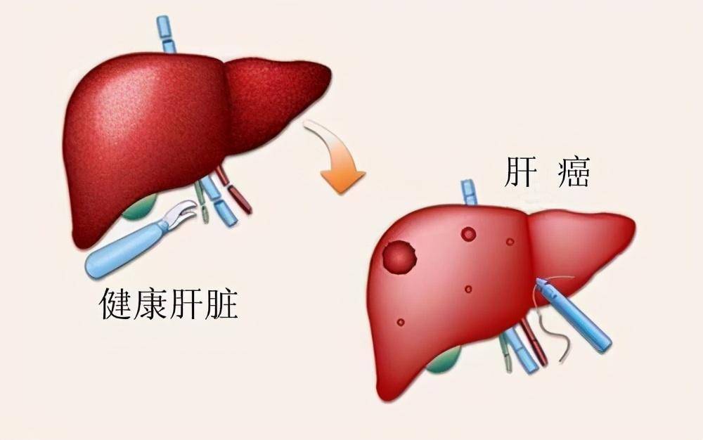 小伙肝癌离世,不抽烟不喝酒,医生:一个习惯保持了10年