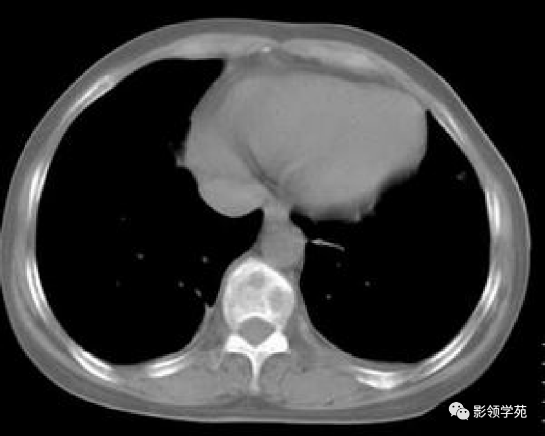 多发性骨髓瘤影像表现_诊断