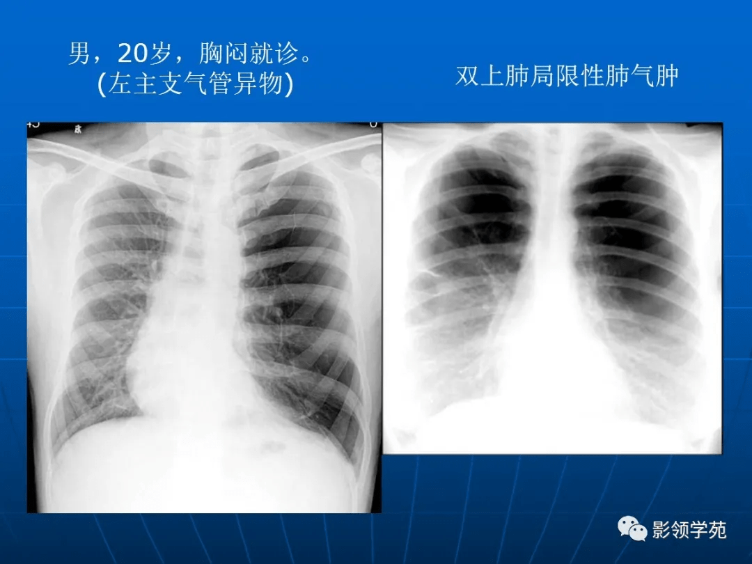 肺气肿的影像诊断