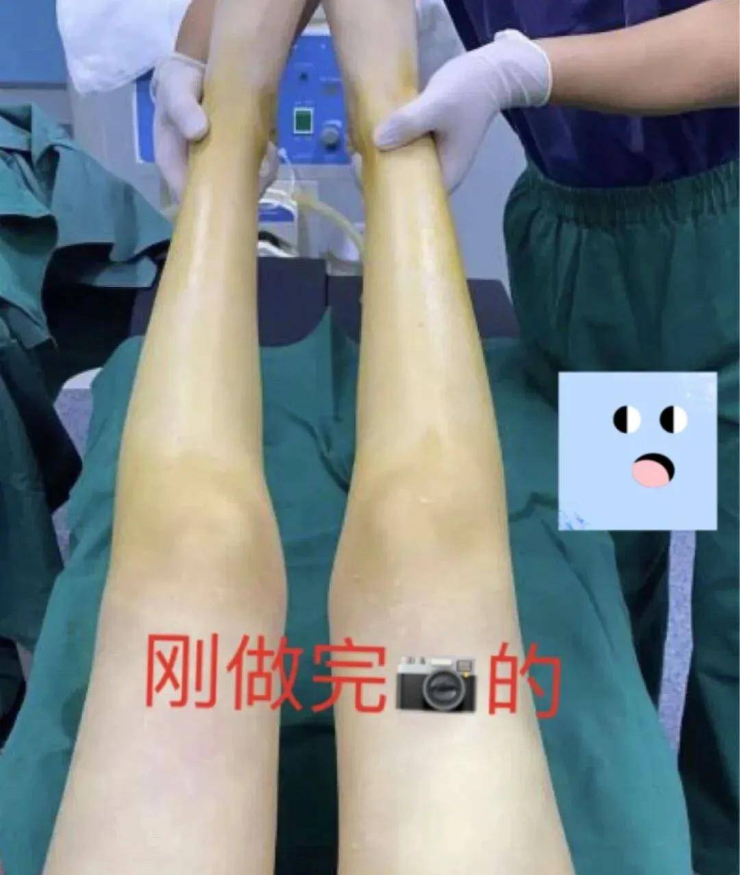 手术|杨幂关晓彤杠上了？撞衫尴尬就算了，还被网友喷做了直腿手术…