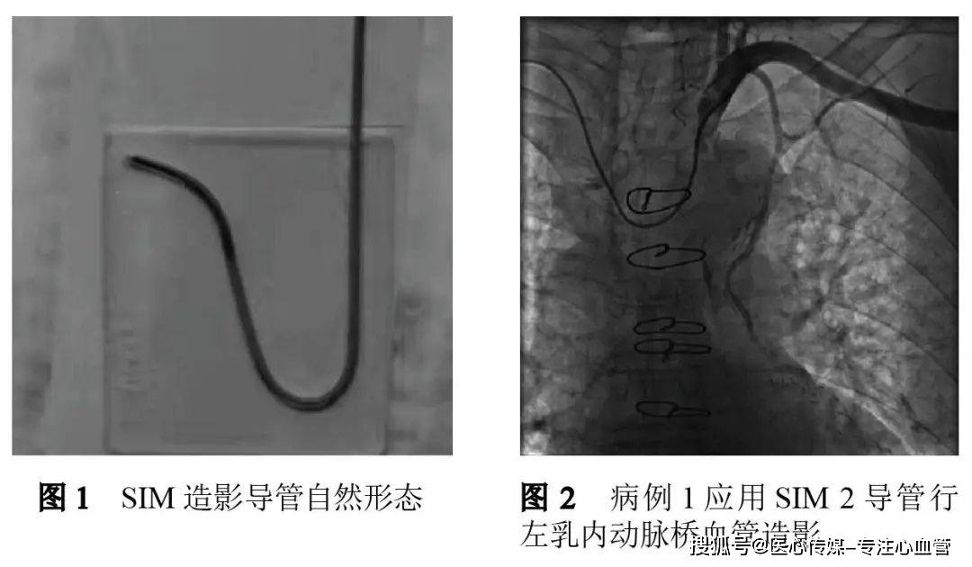 身高换用5 f sim 2或sim 3造影导管(导管形态如图1)行lima桥血管造影