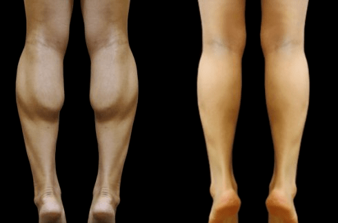 手术|杨幂关晓彤杠上了？撞衫尴尬就算了，还被网友喷做了直腿手术…