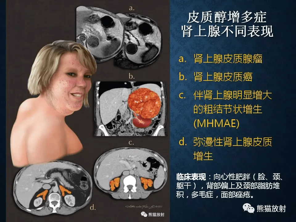 肾上腺扫描方案解剖皮质增生及小腺瘤的诊断