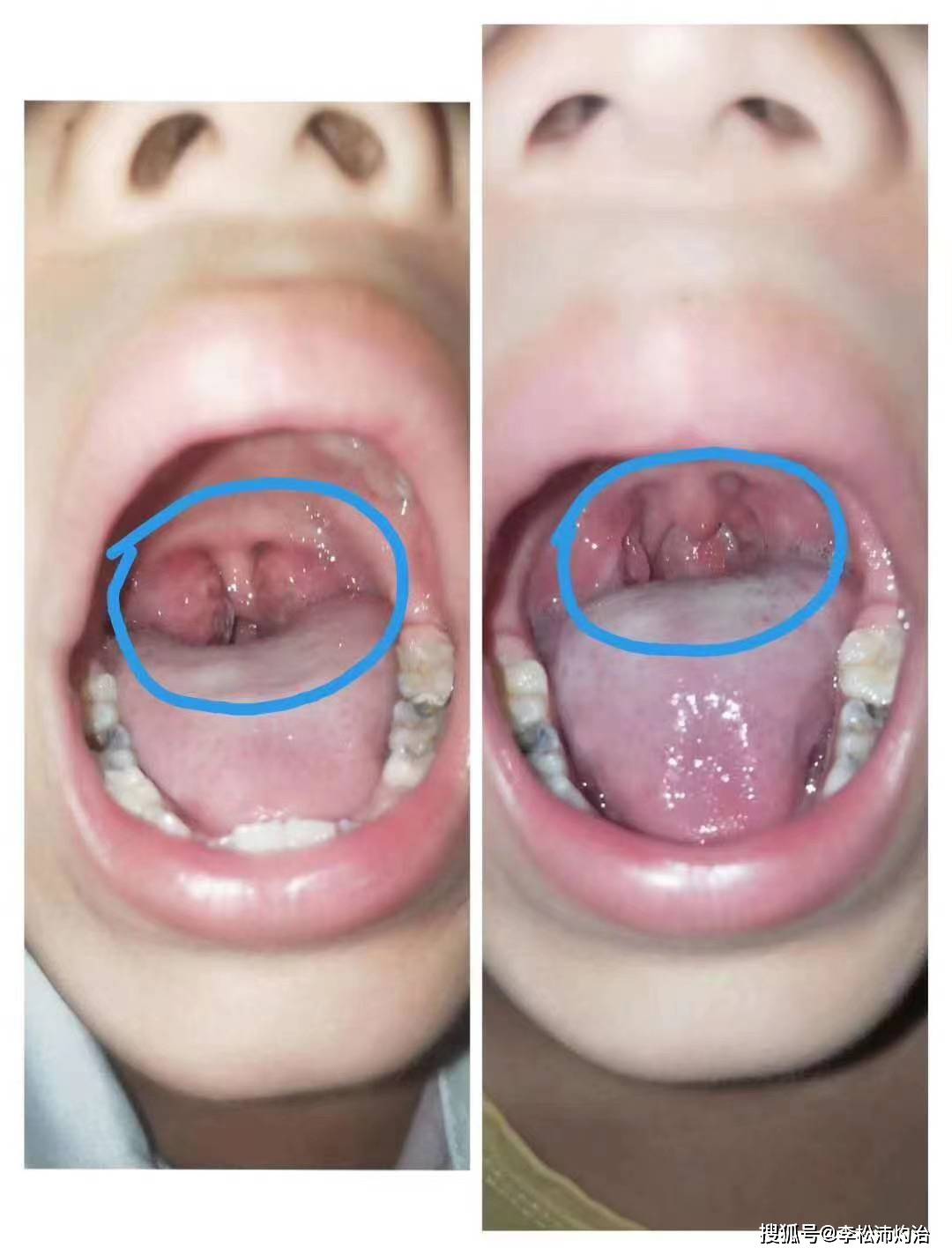 扁桃体灼烙技术后为什么有白色扁桃体灼烙技术能治愈扁桃体肿大