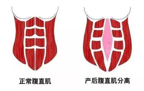 都是腹直肌分离惹的