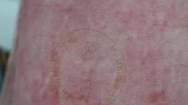 色素沉着图片是什么颜色 108a0500e4e2409e888a525a3b64b57f.jpeg