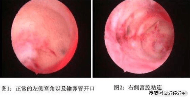 做宫腔镜检查痛不痛?