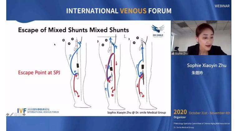 治疗|开幕第一天精彩回顾｜2020国际静脉病论坛持续进行中