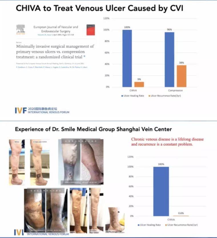 治疗|IVF2020第三场精彩回顾：静脉溃疡和压力治疗专场（今日19:00直播预告）
