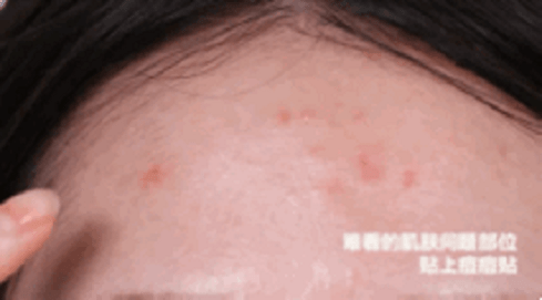 “战痘”界的急救神器：一贴痘痘瞬间隐形！ Elaband痘痘贴！