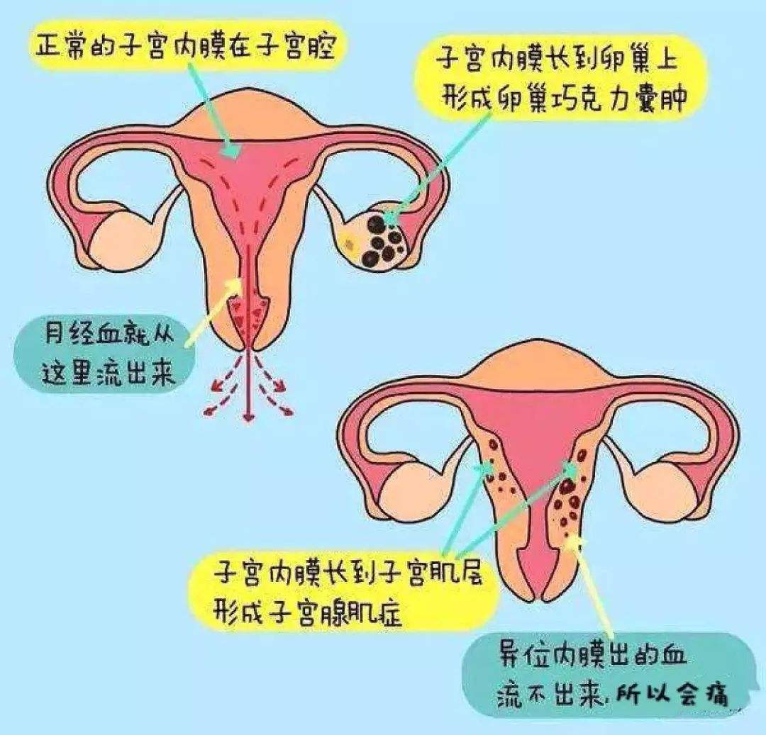 子宫腺肌症＋巧囊，想怀孕该怎么办？