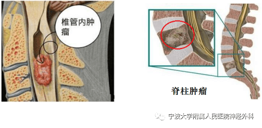 脊髓肿瘤常见问题