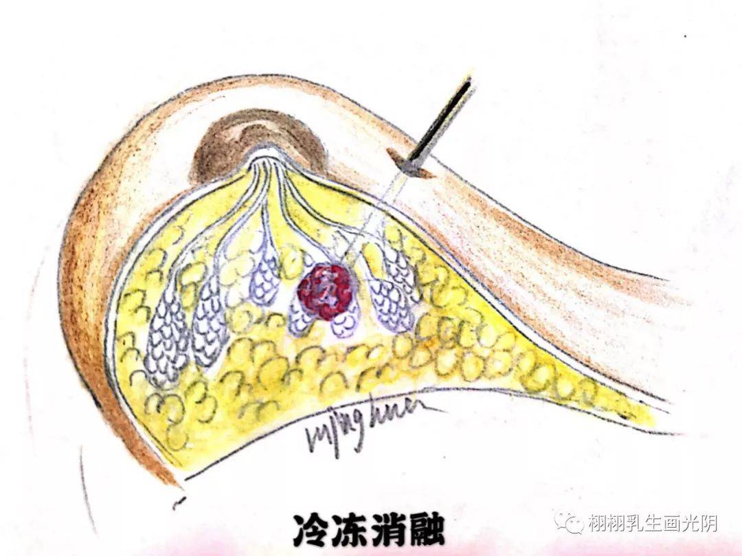 乳腺超声可以引导细针穿刺的过程,可以清楚的显示活检的位置,以帮助