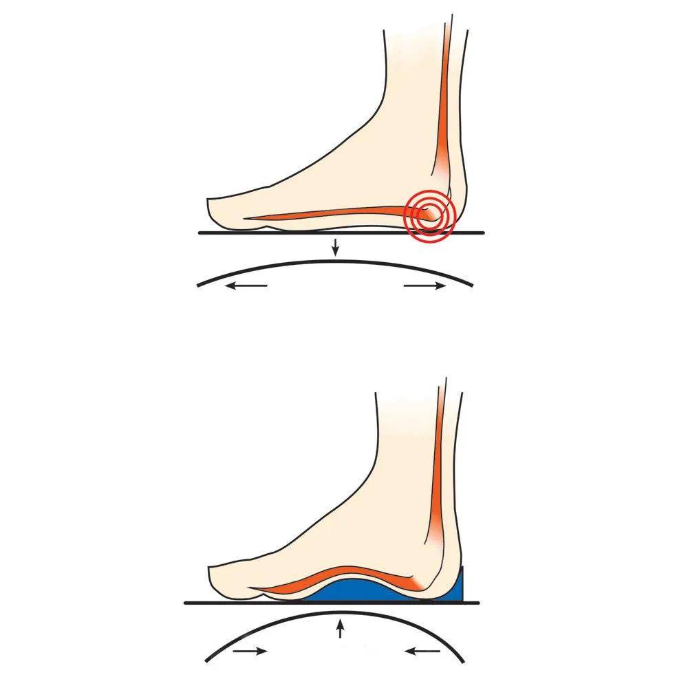 足踝科普系列(一)-足底筋膜炎
