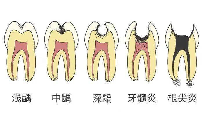 全黑|最伤孩子牙齿的不是糖，而是……4岁男孩牙齿几乎全黑