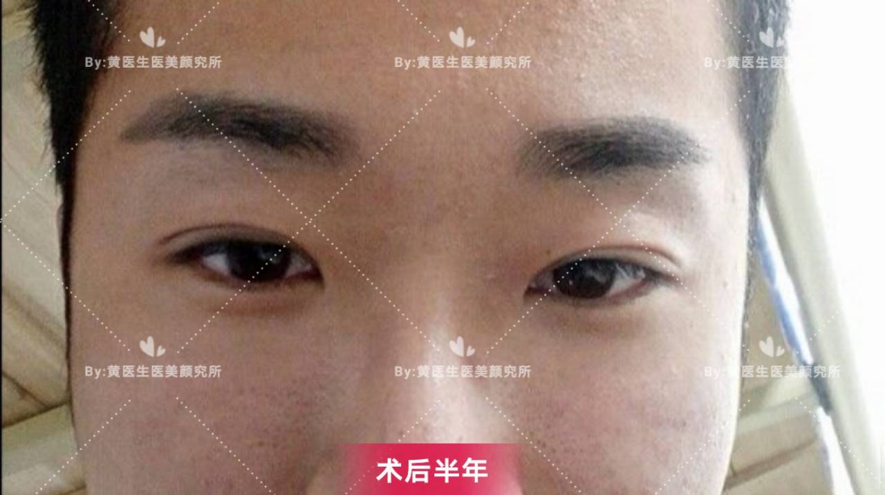 男士双眼皮手术案例