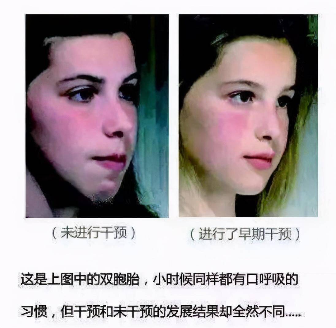 孩子|3个部位越“丑”，长大颜值越高，很少有人三条全中宝刚出生