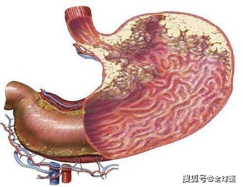 早期胃癌预后比较好,但是晚期胃癌生存率往往低于10,甚至5.