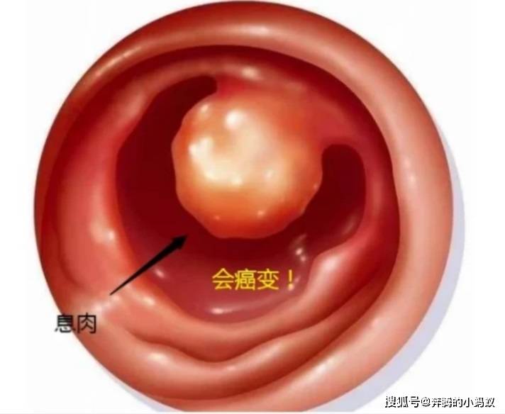担心破坏处女膜,医生就能拒绝为子宫息肉女孩手术?