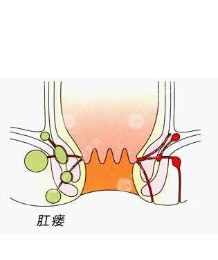 怎么样才会得肛瘘 6f8c4959fa9643ffb76921ef41e06238.jpeg