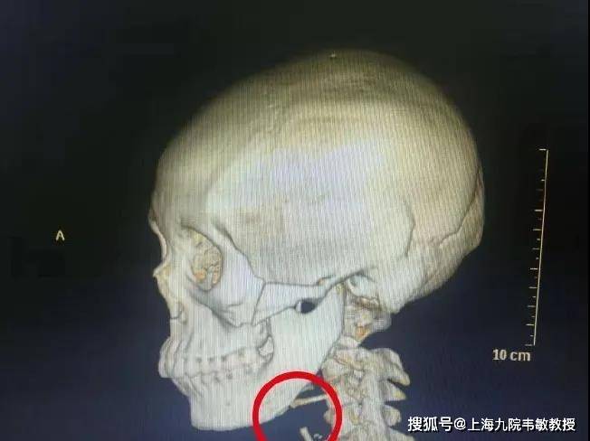 九院韦敏教授丨下颌骨截多长才算长曲线截骨