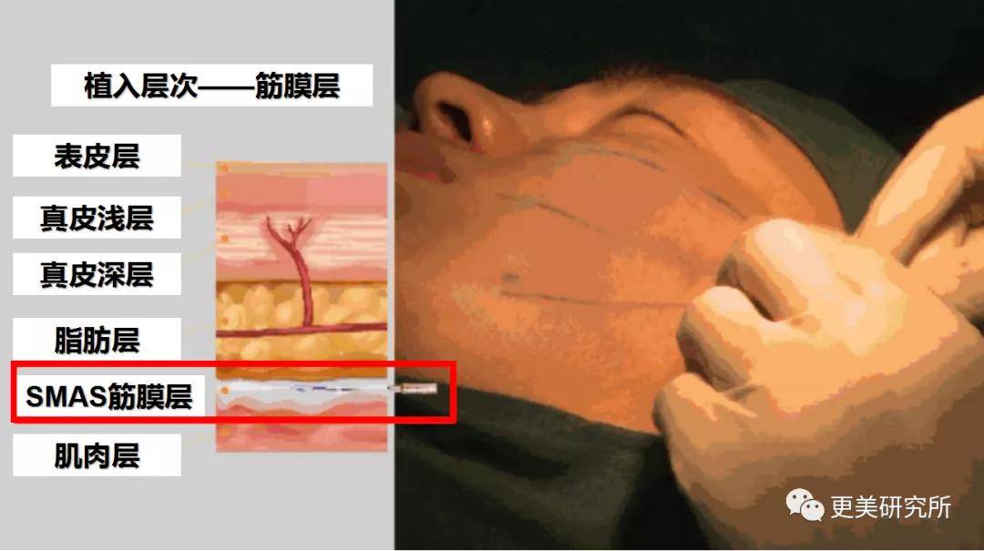 do|热巴“幂”化，28岁就为抗衰do脸？痕迹明显…