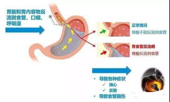 食管反流病胃酸多,能多喝水吗?平时注意哪些问题有助于改善?