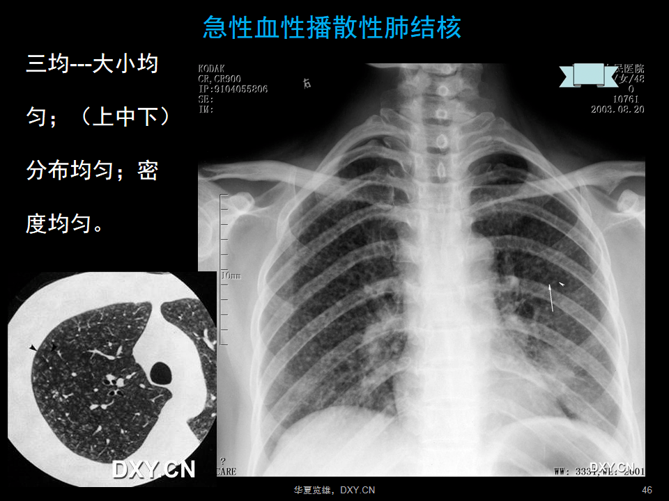 肺炎症,结核,肿瘤在ct及胸片上有哪些区别?