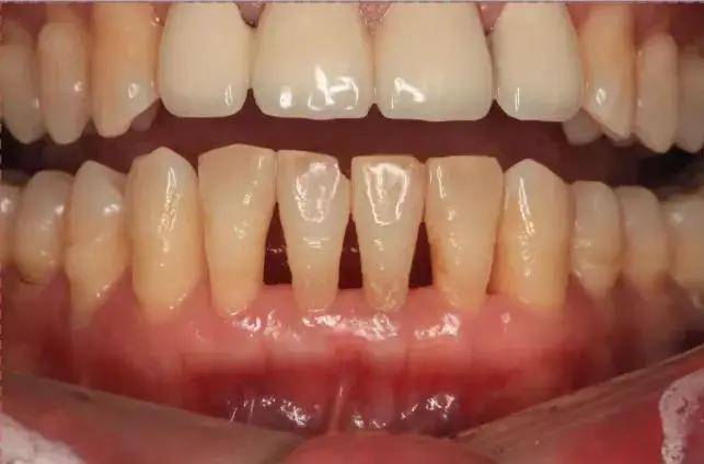 牙龈萎缩又称为牙龈退缩,根面暴露,表现为牙齿"变长",牙根暴露,牙缝