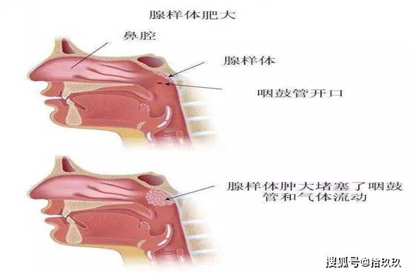 家长们快来看看,孩子长这样是因为生病了,尽快去医院还有的救!